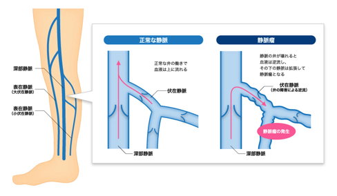 足の静脈には、1本の本流と2本の支流がある