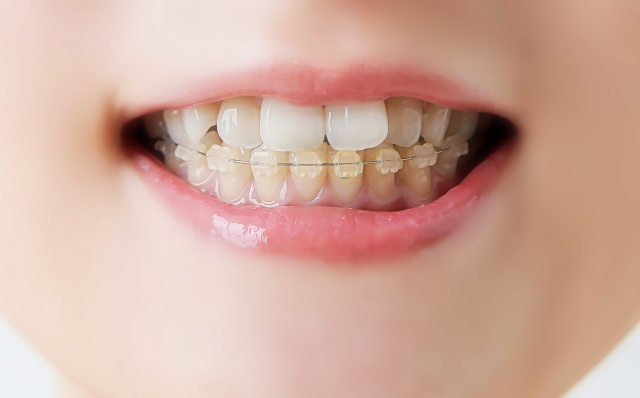出っ歯の概要と抜かない矯正（非抜歯矯正）で治療する方法