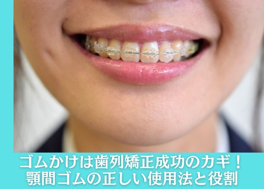 歯科矯正 顎間ゴム ゴムかけ 歯並び エラスティック ワイヤー インビザライン 通販
