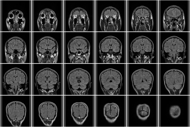 脳ドックでわかることは？ MRI以外にどんな検査をするの？