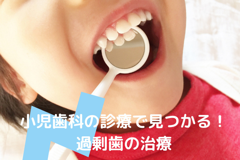 小児歯科の診療で見つかる過剰歯の治療