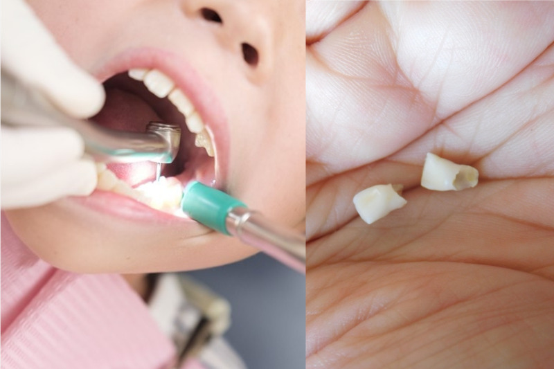 虫歯が欠けるとどんな治療が必要になる？治療法と対策法