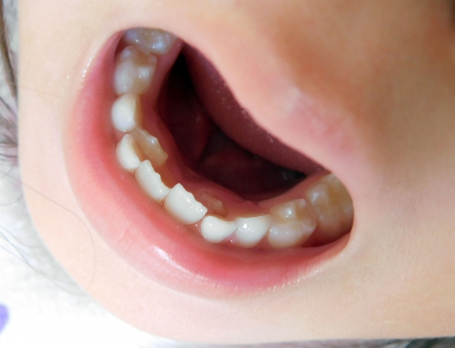 将来のきれいな歯並びのためには、乳歯の矯正が大事ってホント？