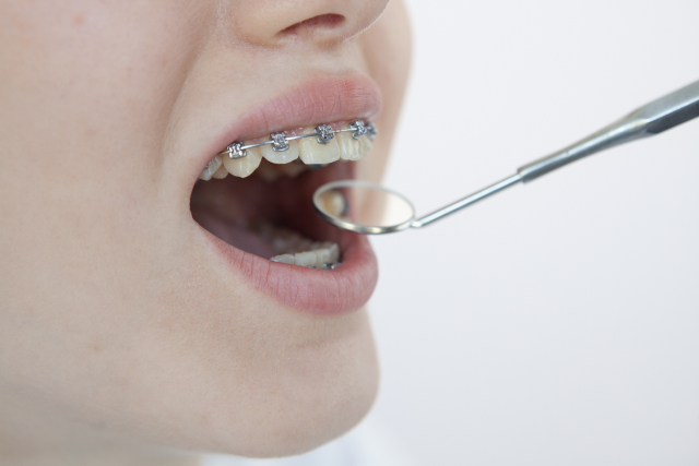 出っ歯や受け口の矯正は「ある条件」で保険適用できる 治療法と合わせて解説