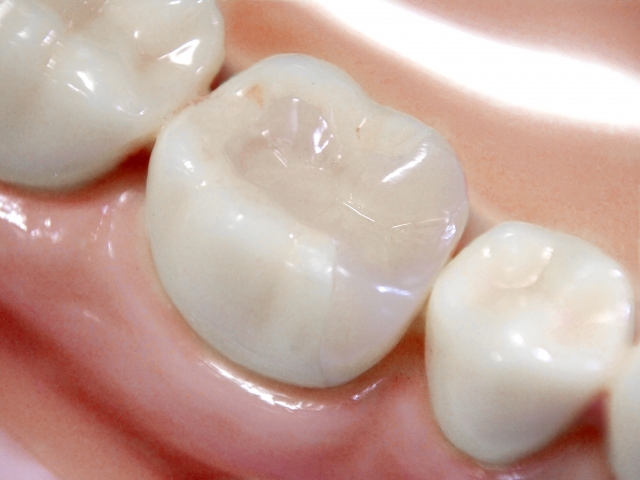セラミックのインレーやクラウン、歯医者が教える寿命を長持ちさせる方法