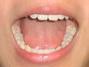 【歯科医師に聞く】親知らずの抜歯は必要？ 手術の流れとは