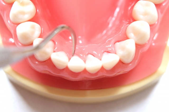 歯周病予防にはプラークの除去が重要
