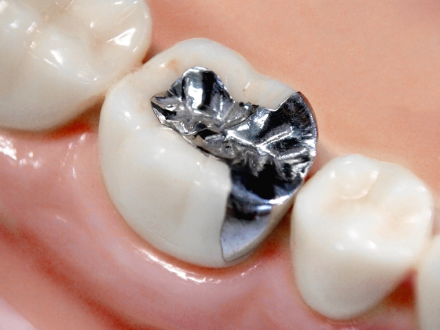 銀歯との比較