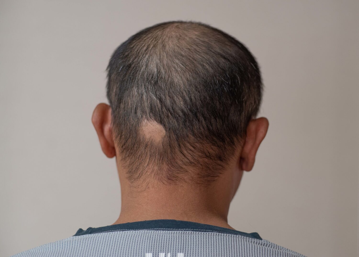 重症円形脱毛症、バリシチニブが毛髪再生を促すとの研究結果【医師による海外医学論文解説】