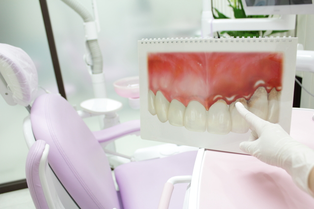 歯周病になるのはなぜ？