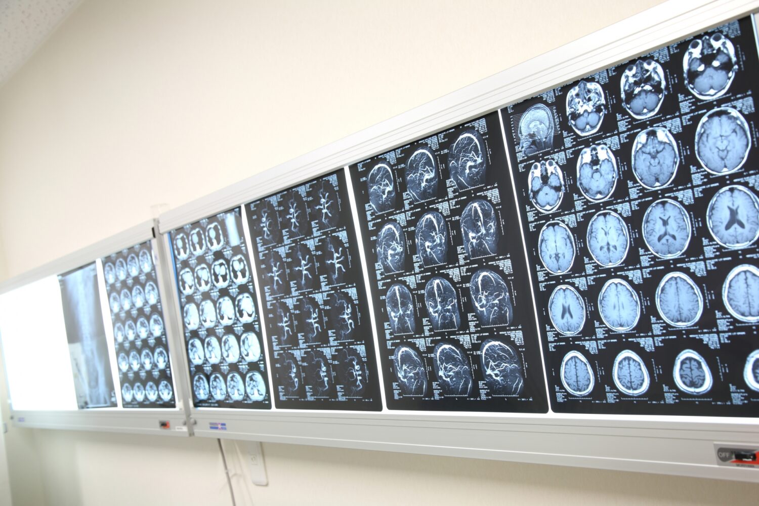 脳幹出血を疑う場合の対処法や検査方法