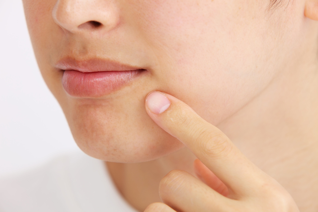 顔の赤みの原因・治療法を皮膚科専門医が解説、引かない場合はどんな疾患が考えられる？