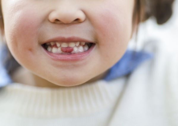 MFT（口腔筋機能療法）とは？ 歯科医が小児の歯並びに良い舌・口のトレーニングを解説