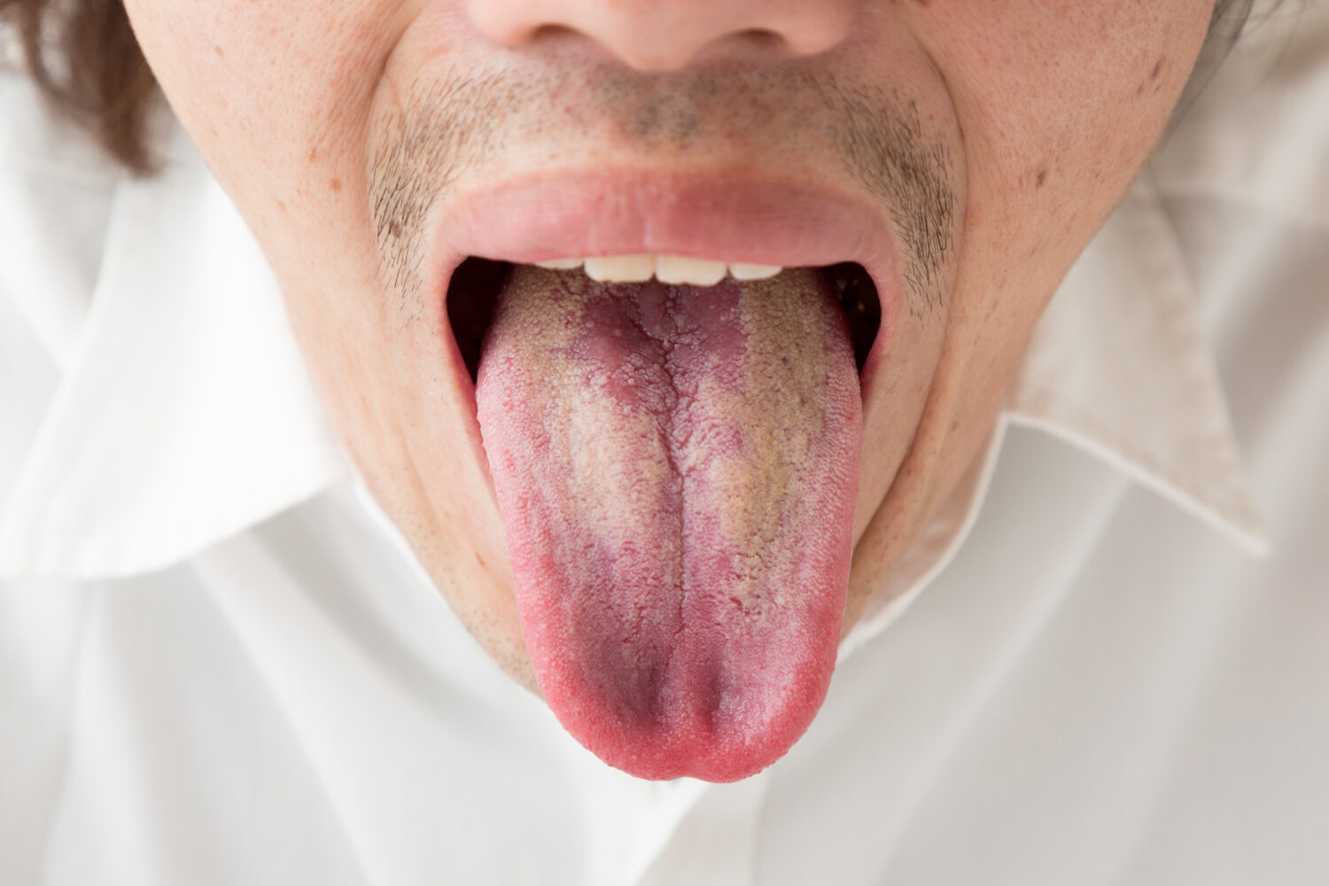 「白板症」になると口の中に現れる症状はご存知ですか？医師が監修！