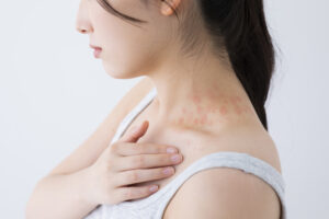 「温熱蕁麻疹（皮膚温度の上昇による蕁麻疹） 」ができる原因はご存知ですか？