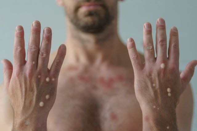 サル痘 性行為中の皮膚接触が主な感染経路と報告