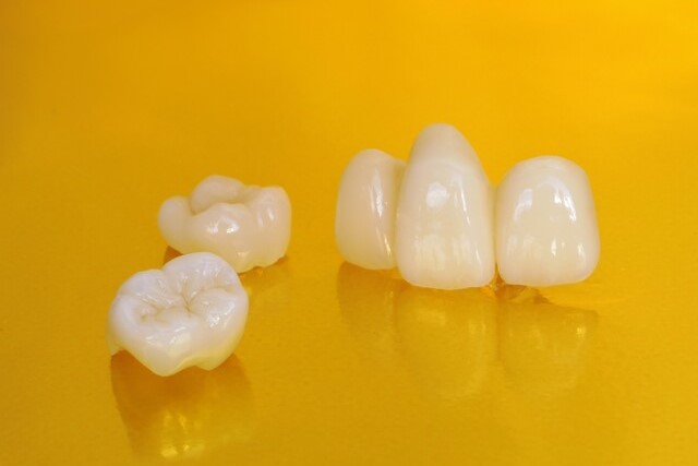 セラミックの歯の詰め物の種類を歯科医が解説 ジルコニア・アルミナ・ハイブリッドの違いは？