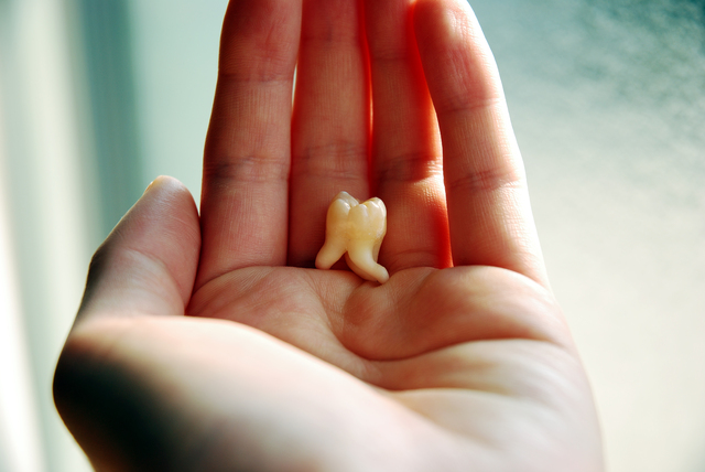 歯科で抜歯が「難しい」のはどんな親知らず？