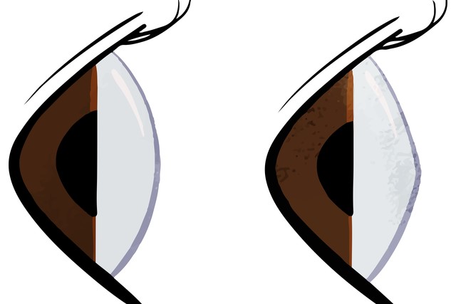 円錐角膜とは目のどんな病気？見え方･視力の症状や治療法について知りたい