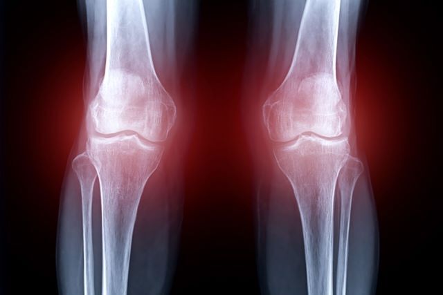 変形性膝関節症とはどんな膝の病気？病院やクリニックに行かずに自力で治すことはできる？