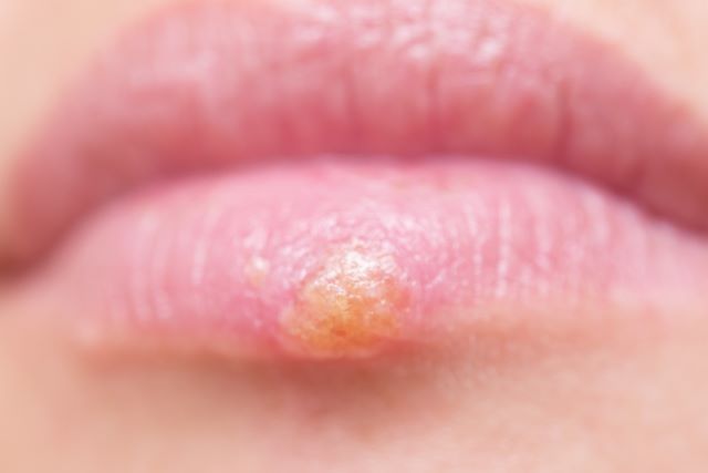 口唇ヘルペスとは 原因と症状を解説
