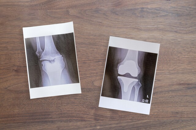 中高年の膝の痛みの主な原因･病気は？ 膝の症状を放置するとどうなる？
