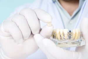 インプラントの寿命を歯科医が解説 耐用年数と長寿化メンテナンス･寿命後は交換すべき?
