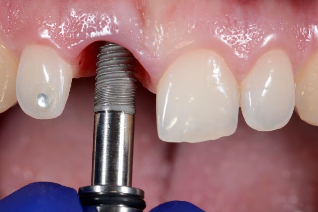 インプラントができない場合の主な理由 前歯･奥歯、歯ぐきなどのケースで歯科医が説明
