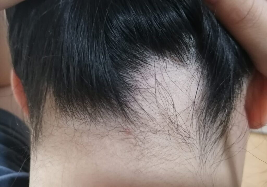 円形脱毛症の症例