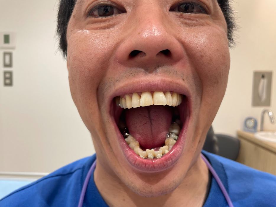 歯列矯正 治療経過写真
