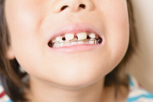 ｢子どものうちに歯列矯正をすると良いワケ｣を歯科医が解説 治療の開始タイミングや費用も知りたい