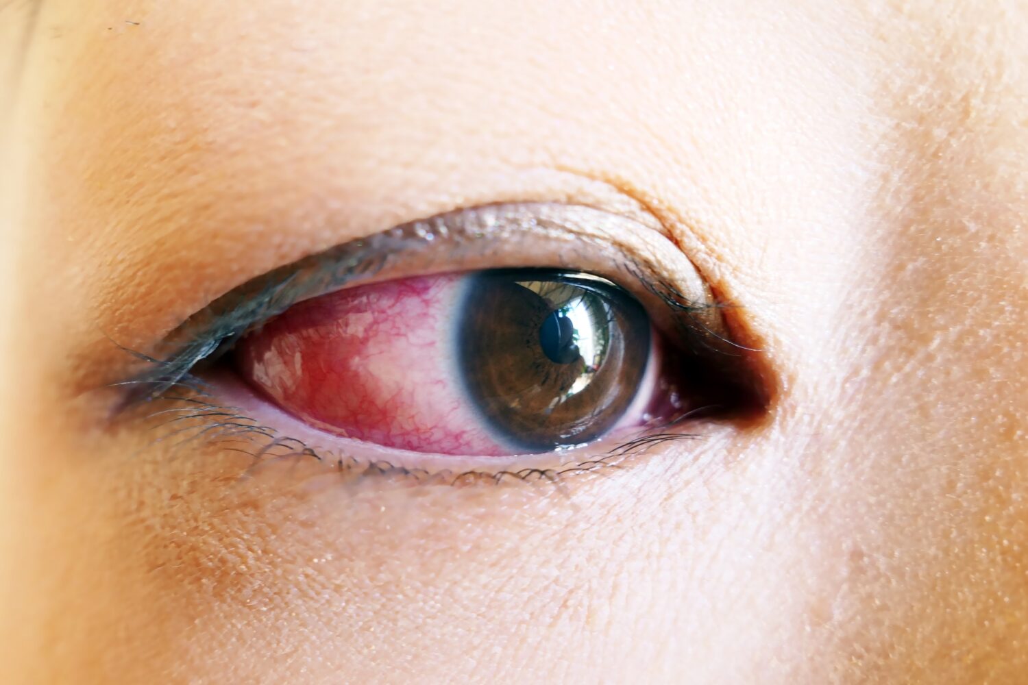Subconjunctival Hemorrhage: Odd Bloody Stains in the Eyes - The DailyMoss