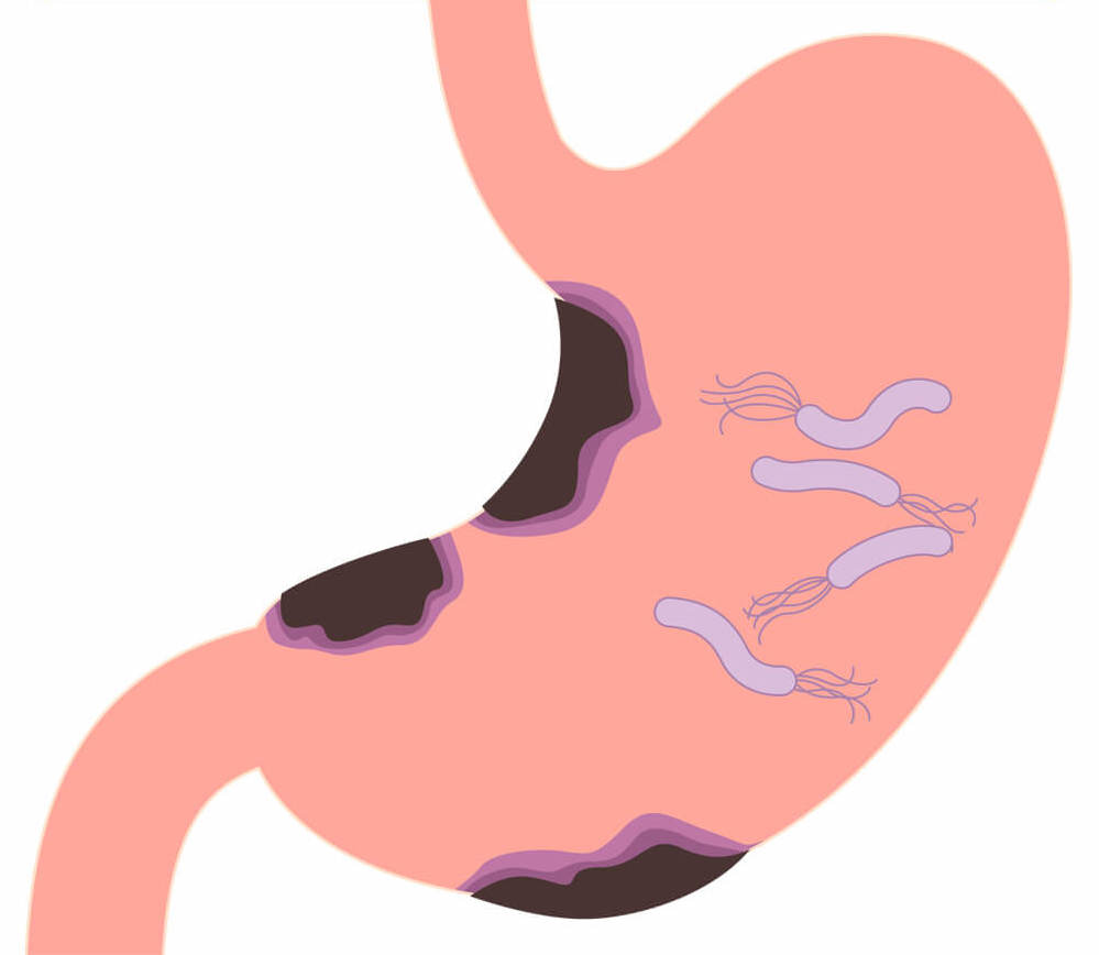 胃がんと深く関わるピロリ菌