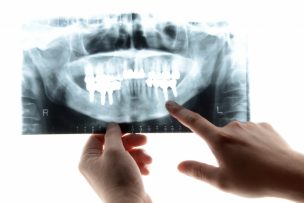 歯周病治療は、なぜ頻繁に検査するの？（再評価検査について）