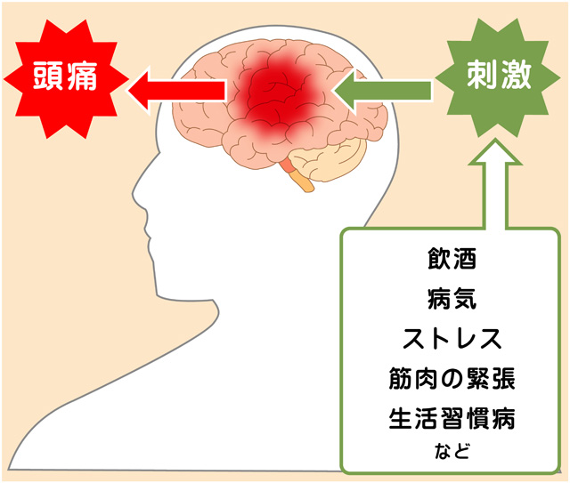 重大な病気の可能性も 頭痛の種類を知って正しい対策を