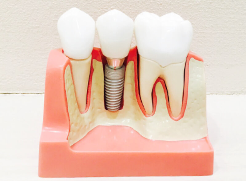 インプラントの人工歯って、どうやって選べばいいの？