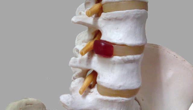 腰椎椎間板ヘルニアとは何かを理解する